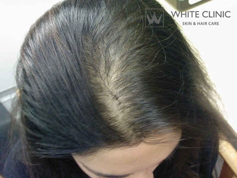 Đường Chân Tóc Thưa Mỏng: Nguyên Nhân Và Giải Pháp Điều Trị Hiệu Quả 