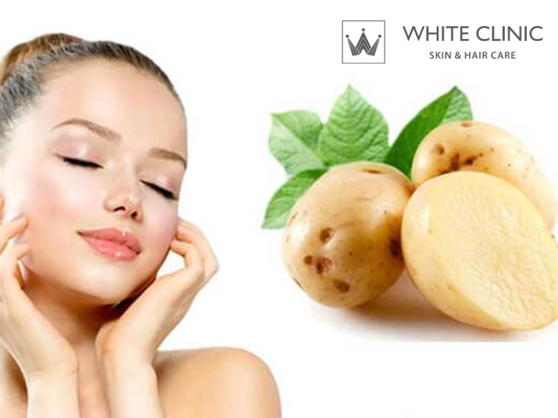 trị mụn bằng khoai tây