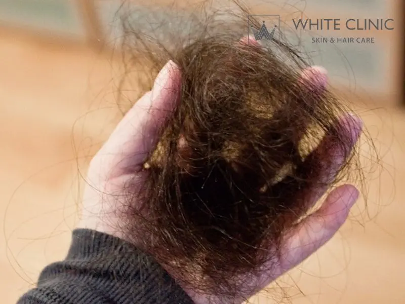 Tóc Rụng Nhiều Bất Thường Nguyên Nhân Do Đâu Và Phương Pháp Điều Trị 