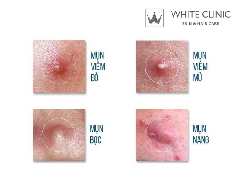 mụn viêm