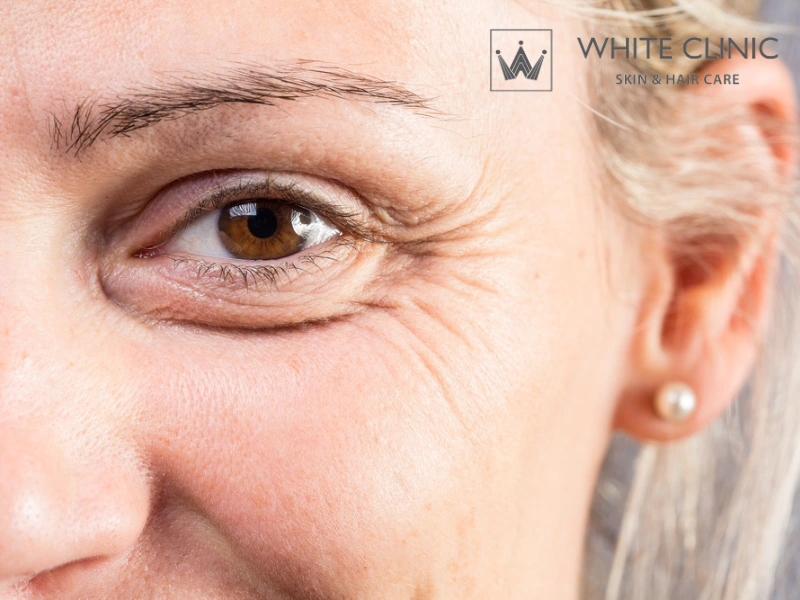 cách trị nếp nhăn ở mắt