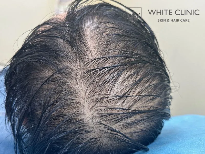 minoxidil minoxidil