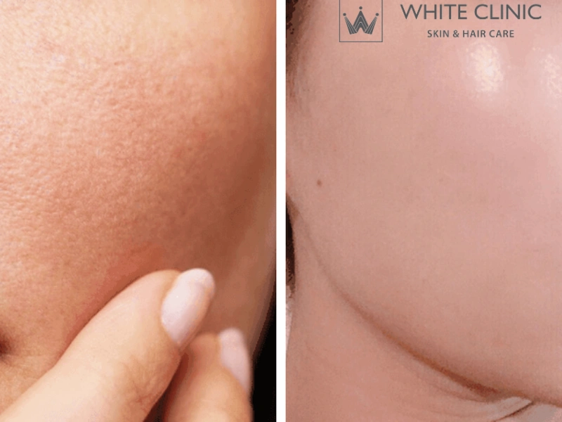 se khít lỗ chân lông mặt se khít lỗ chân lông mặt