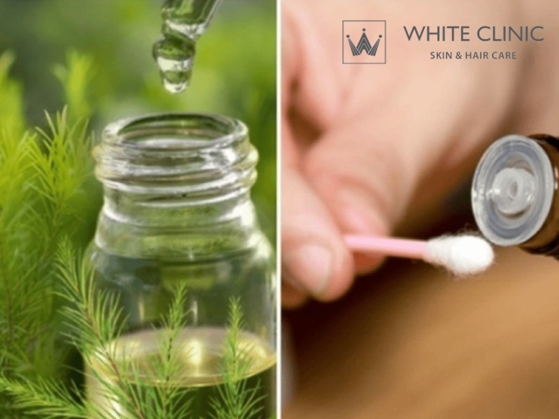 trị mụn bằng tinh dầu tràm