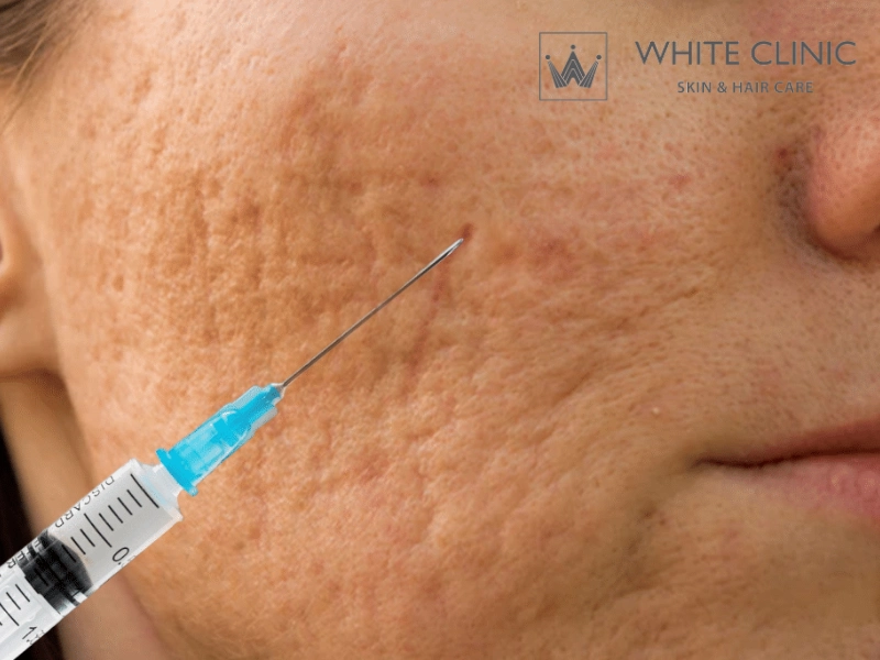 tiêm filler làm đầy sẹo lõm tiêm filler làm đầy sẹo lõm