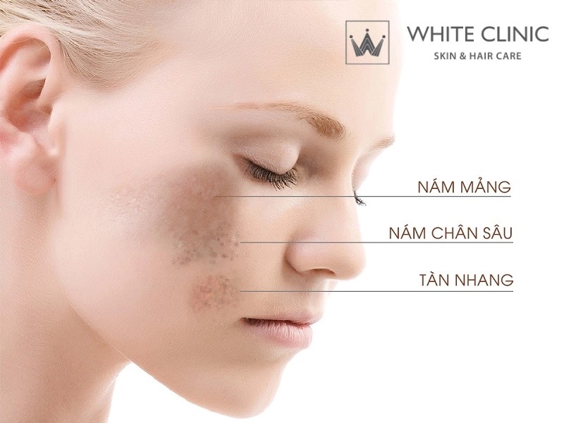 Các Loại Nám Da: Nhận Diện Đúng Tình Trạng Để Chọn Phác Đồ Điều Trị Hiệu Quả
