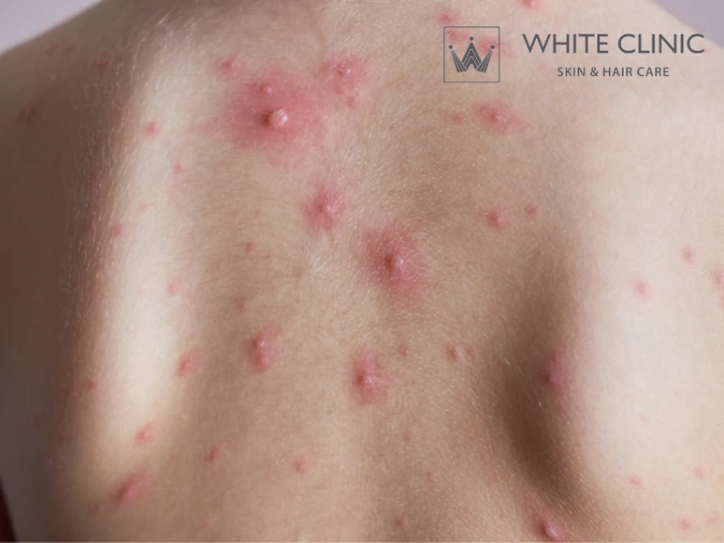 thuốc trị sẹo trái rạ
