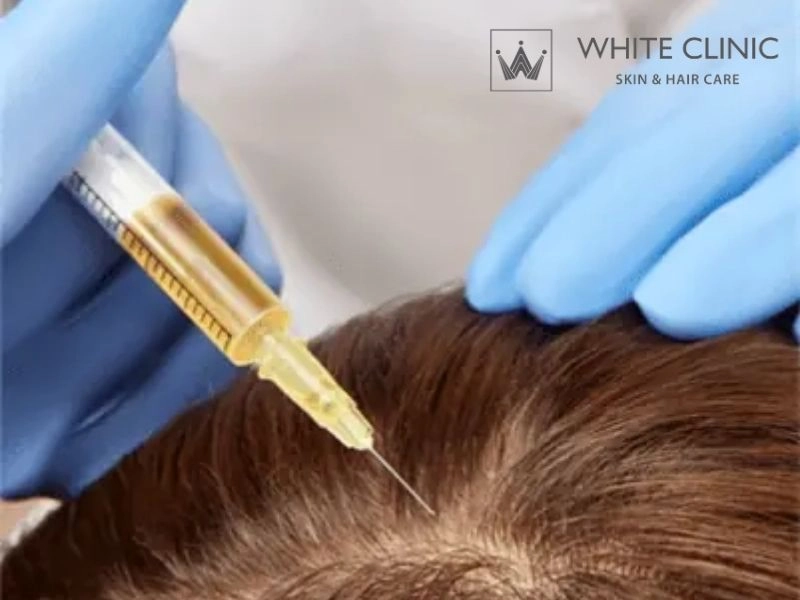 Tiêm PRP trị rụng tóc có hiệu quả không