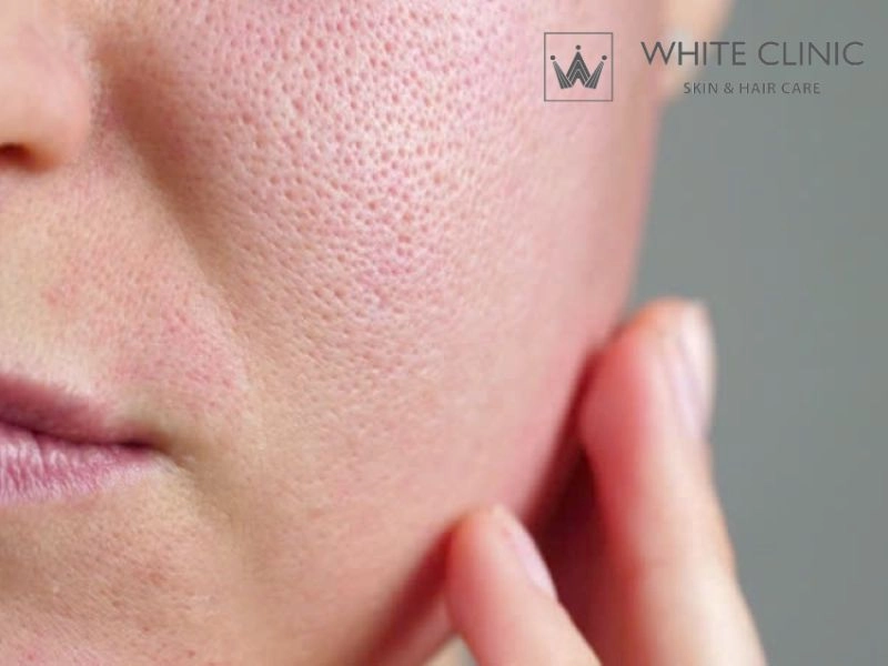 Sẹo Đáy Vuông (Boxcar Scar): Giải Mã Cơ Chế Và Phác Đồ Điều Trị Chuyên Sâu 