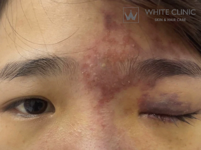 xử lý biến chứng filler xử lý biến chứng filler