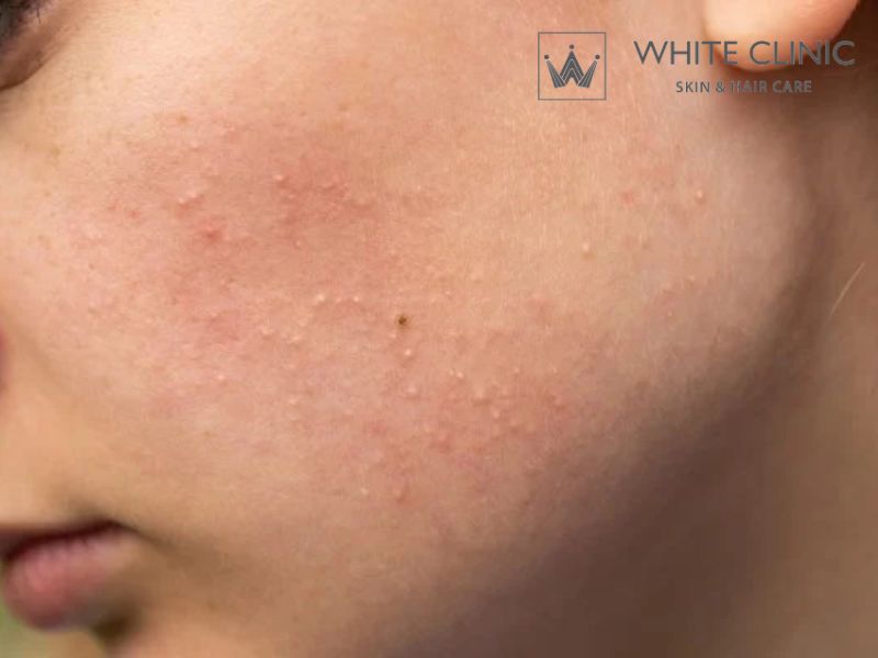 Mụn Ẩn Là Gì? Nguyên Nhân Hình Thành Và Giải Pháp Điều Trị 