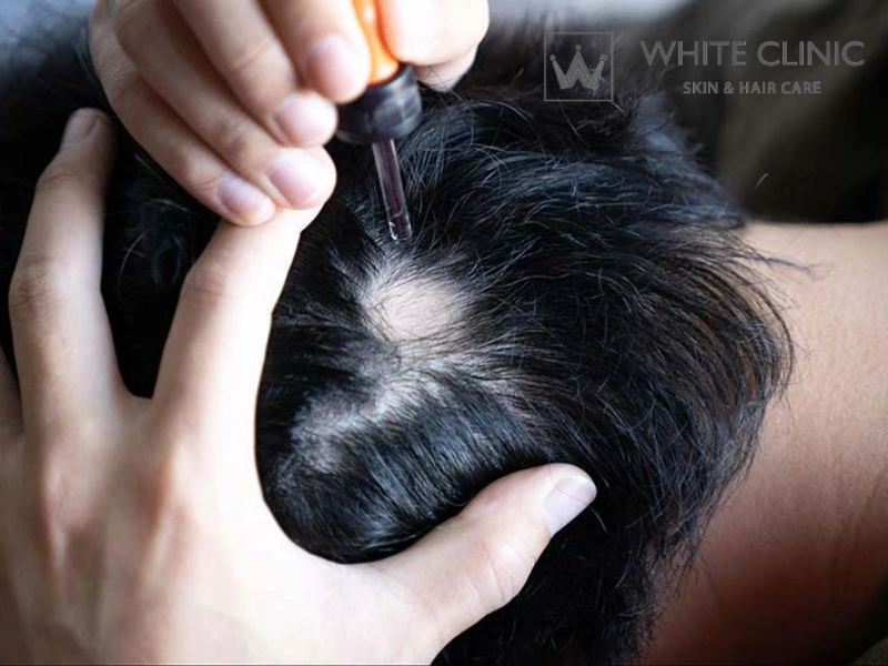 Alopecia Areata Là Gì? Điều Trị Rụng Tóc Dạng Mảng Và Phác Đồ Cá Nhân Hóa 