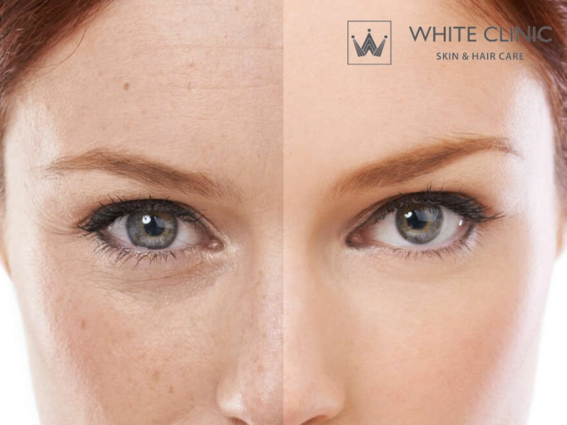 Trẻ Hóa Da Bằng Laser Có Tốt Không? Giải Đáp Thắc Mắc Từ Chuyên Gia 