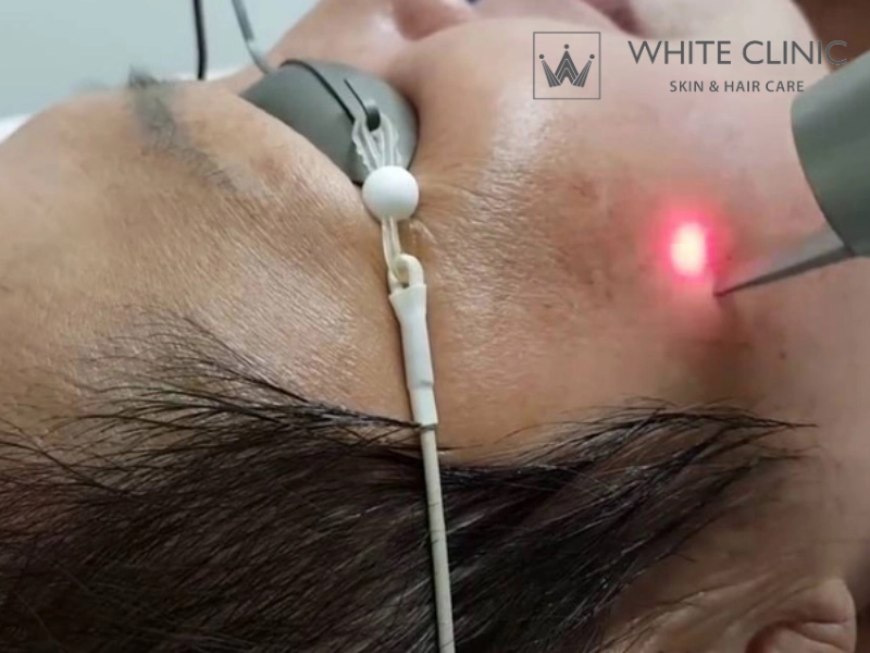 có nên bắn laser trị nám có nên bắn laser trị nám