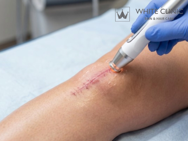 cách chăm sóc sẹo sau phẫu thuật