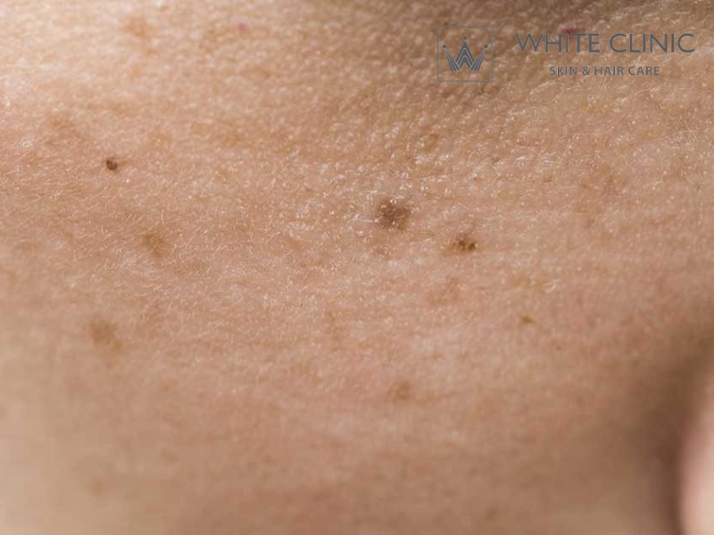 thâm đen sau mụn