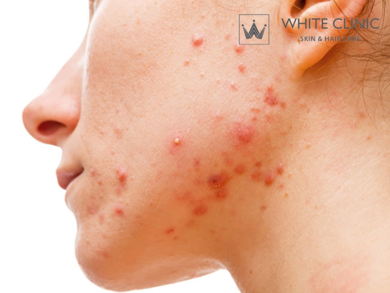 Mụn Nội Tiết Là Gì? Nguyên Nhân Đến Từ Đâu Và Phương Pháp Điều Trị Hiệu Quả 