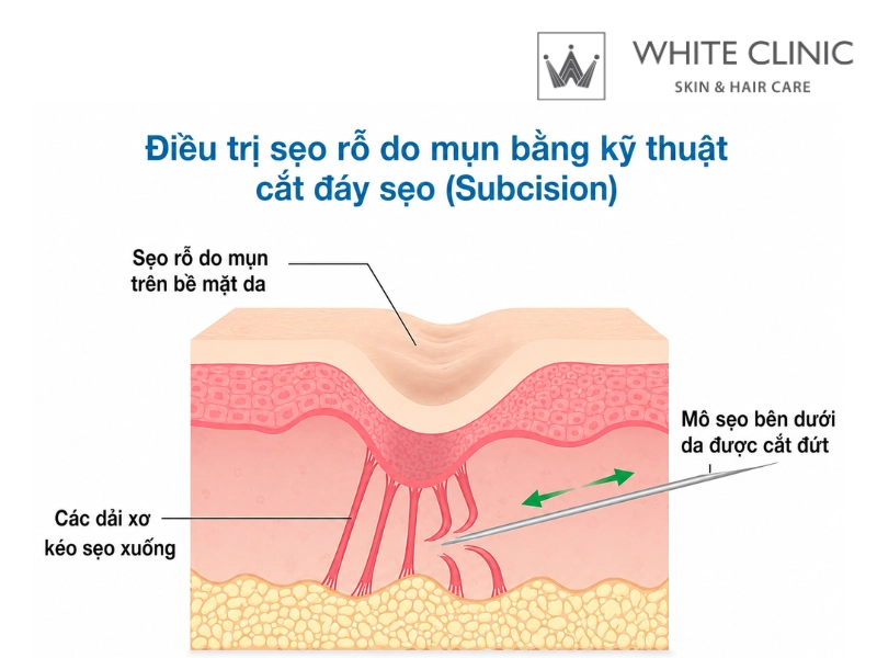 kỹ thuật bóc tách đáy sẹo kỹ thuật bóc tách đáy sẹo
