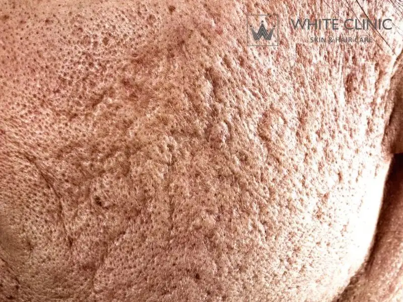 Sẹo lượn sóng Sẹo lượn sóng