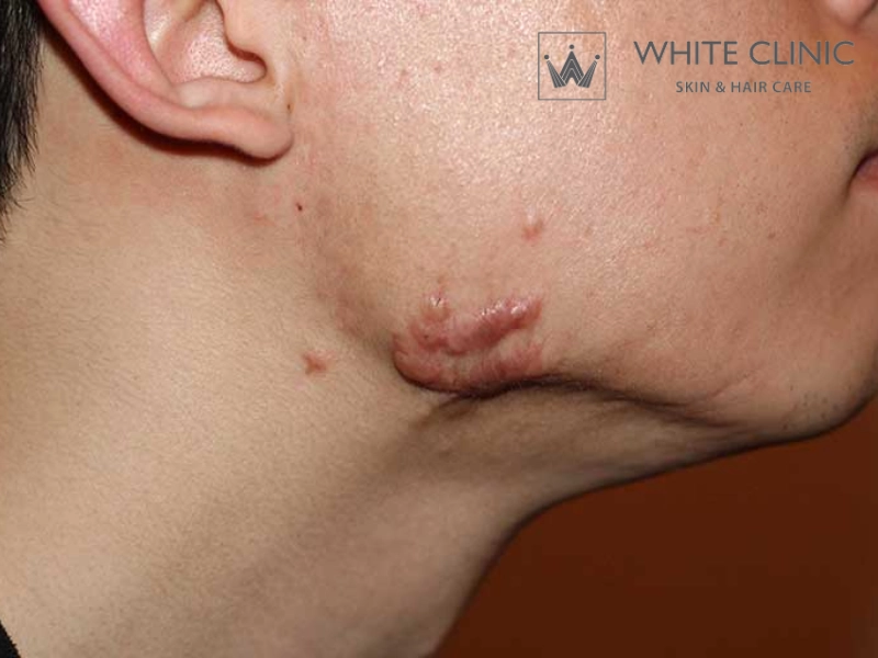 sẹo lồi do mụn trứng cá