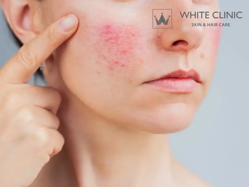 trị thâm đỏ sau mụn