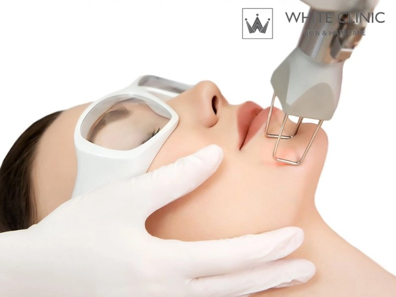 laser co2 fractional laser co2 fractional