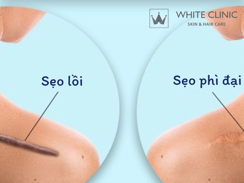 sẹo phẫu thuật sẹo phẫu thuật