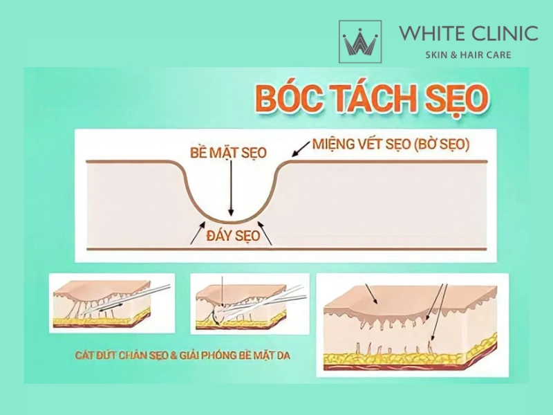 cắt đáy sẹo rỗ cắt đáy sẹo rỗ