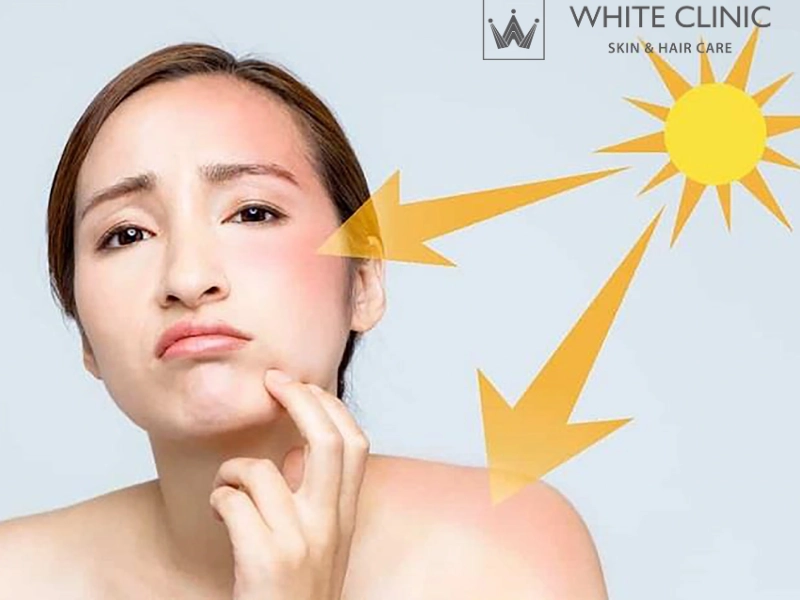 phục hồi da mặt bị cháy nắng