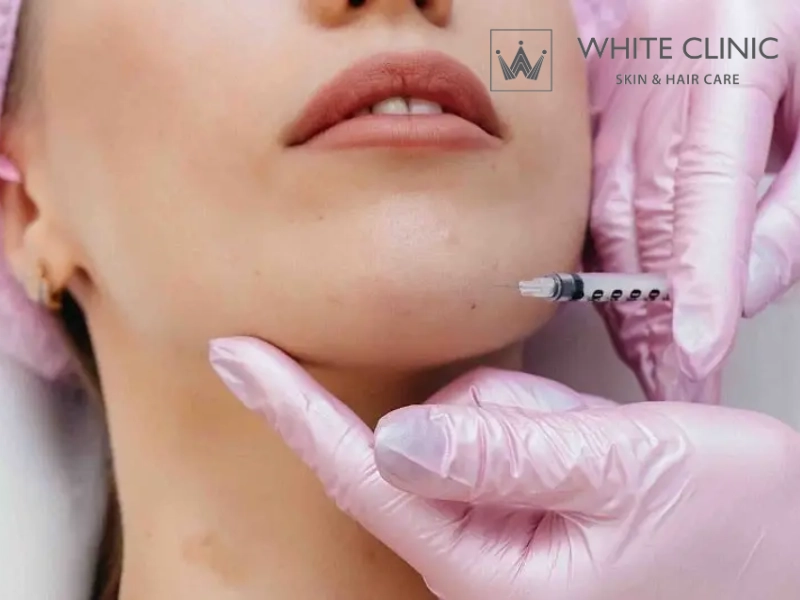 Rủi ro lồi cục sau khi tiêm filler sẹo lõm là gì? Rủi ro lồi cục sau khi tiêm filler sẹo lõm là gì?