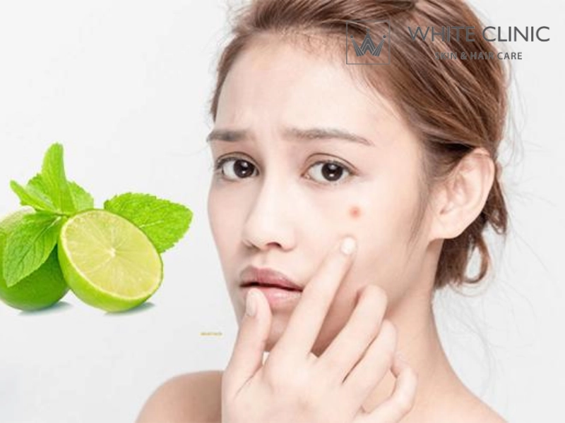 cách trị mụn tại nhà