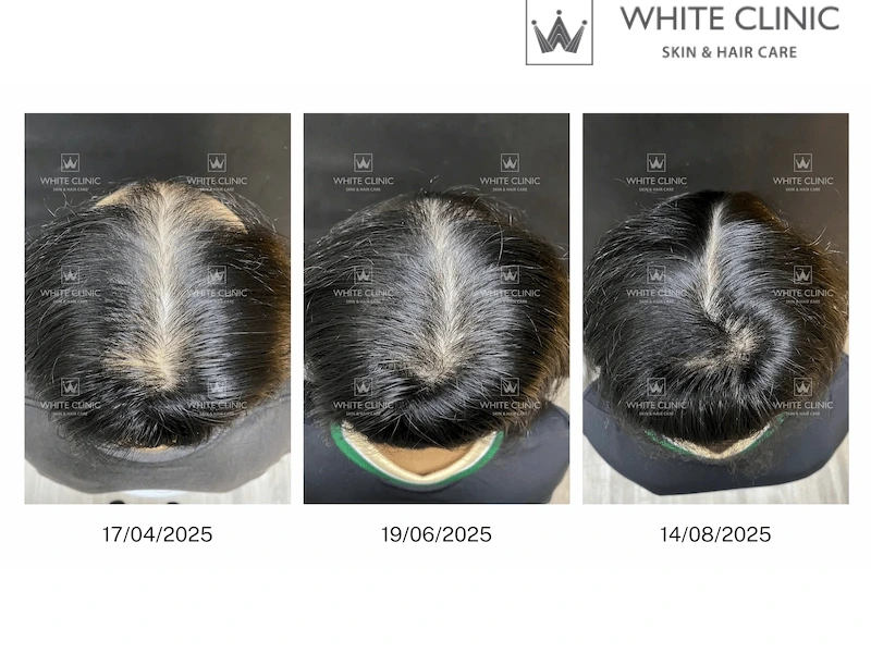 tóc rụng sau sinh