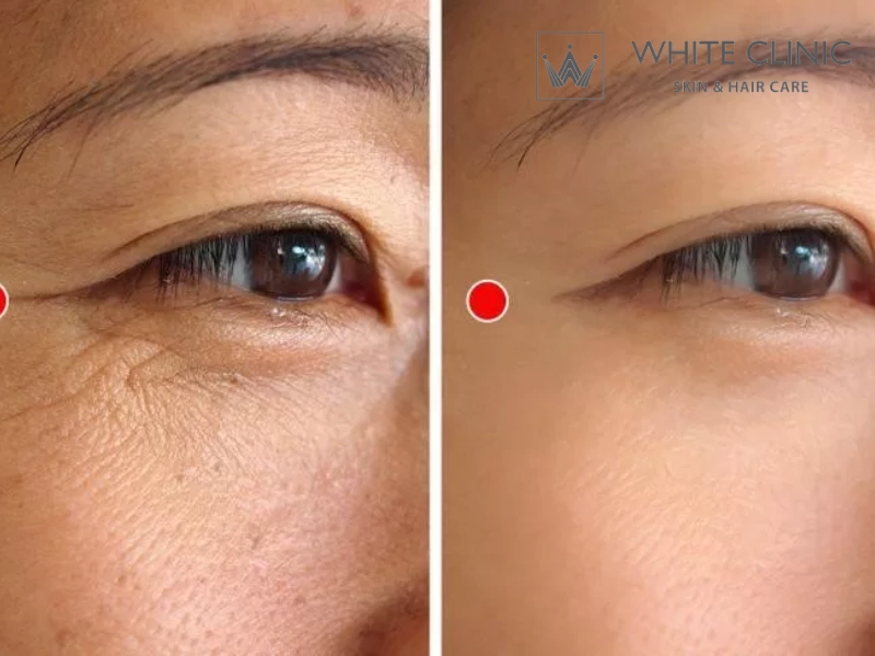 so sánh laser CO2 và Er:YAG