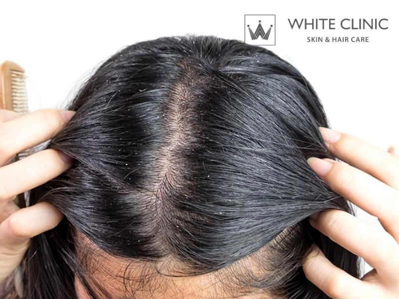 da đầu nhờn rụng tóc da đầu nhờn rụng tóc