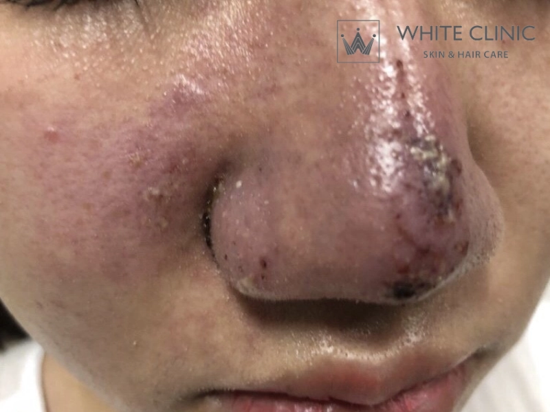 Xử Lý Biến Chứng Sau Tiêm Filler: Dấu Hiệu Nhận Biết Và Hướng Xử Trí An Toàn