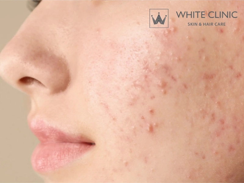 các loại mặt nạ trị mụn và vết thâm