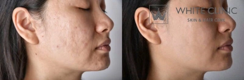 laser co2 fractional bao lâu làm 1 lần laser co2 fractional bao lâu làm 1 lần