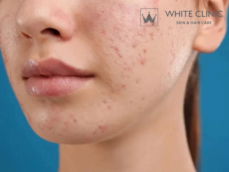 mặt nạ khoai tây trị mụn và vết thâm mặt nạ khoai tây trị mụn và vết thâm