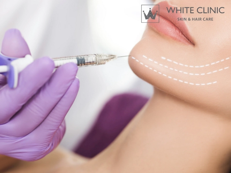 Xóa nhăn làn da với tiêm filler tại White Clinic 