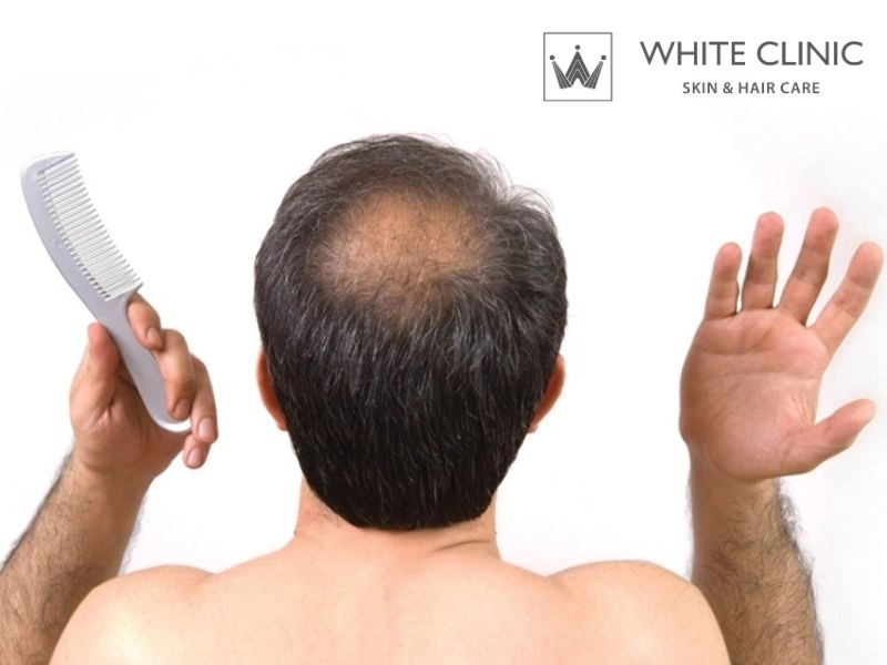 Những Nguyên Nhân Gây Hói Sau Đầu: Dấu Hiệu Và Phường Pháp Điều Trị 