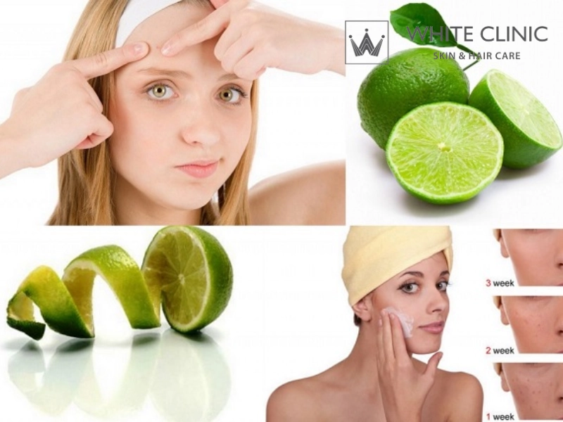 trị mụn bằng chanh