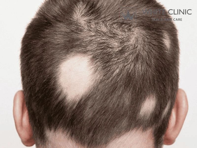 alopecia areata alopecia areata