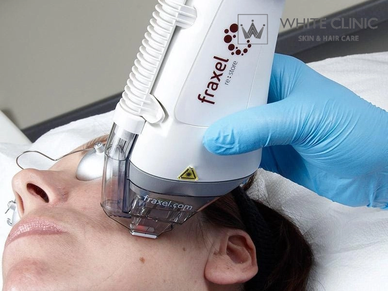 laser co2 fractional có đau không laser co2 fractional có đau không