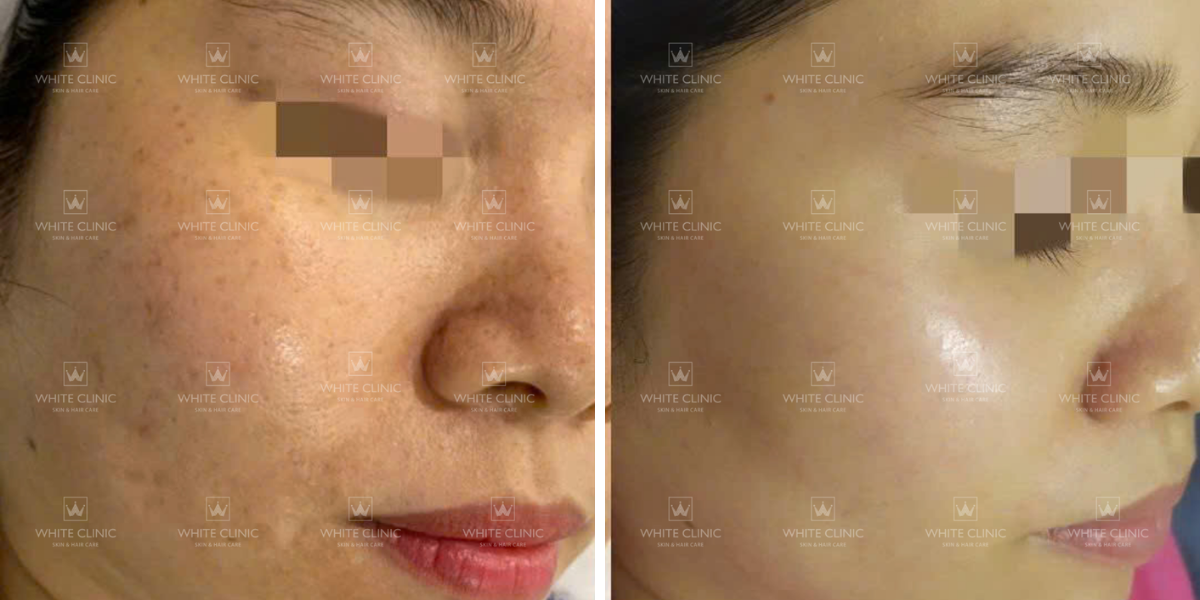 Đồi mồi tàn nhang