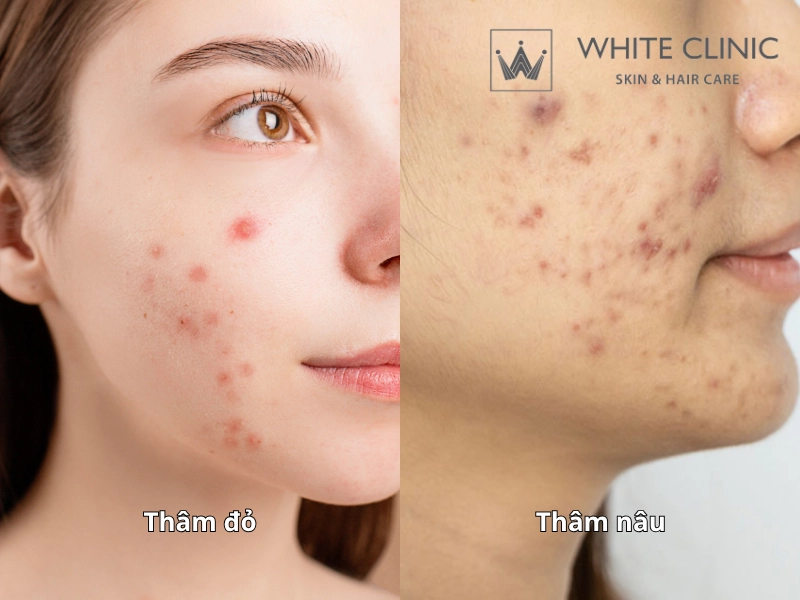trị sẹo thâm