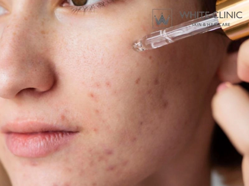 Phương pháp điều trị mụn sẩn hiệu quả và an toàn hiện nay