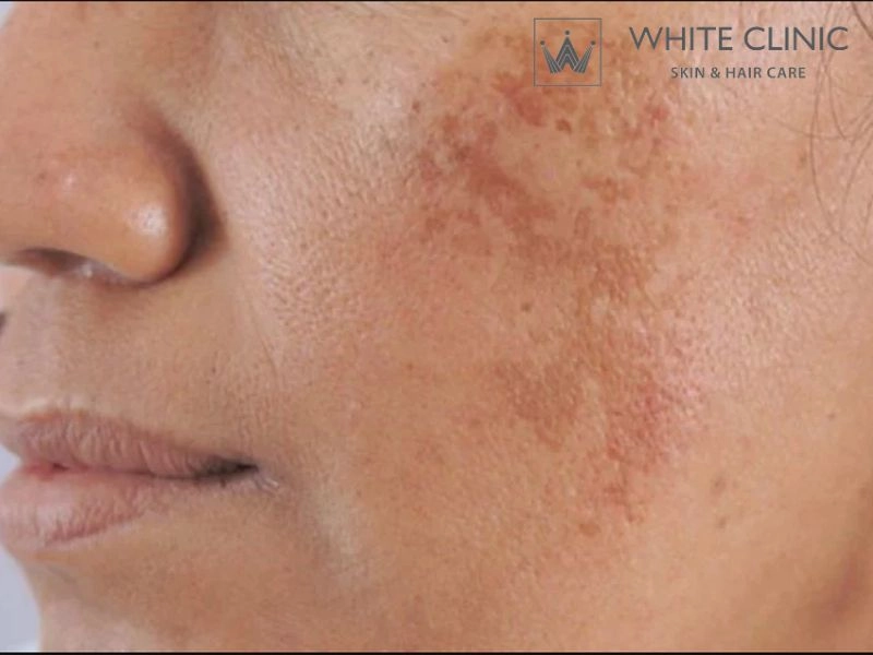 phương pháp trị nám phương pháp trị nám