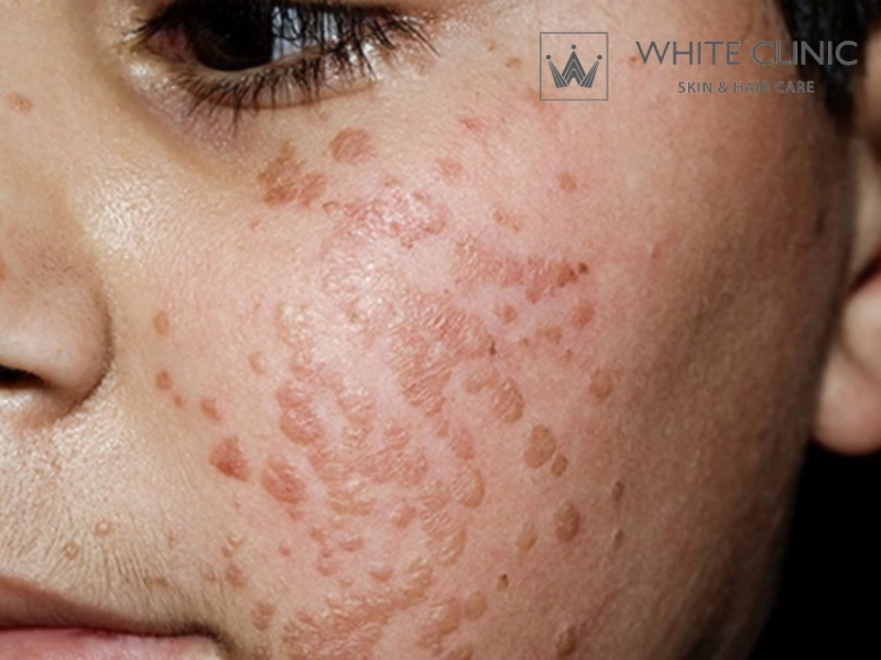 Mụn Cơm: Nguyên Nhân Gây Nên Mụn Và Phác Đồ Điều Trị Hiệu Quả 