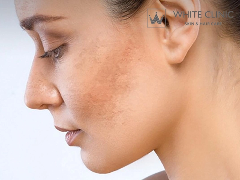 Nguyên nhân gây nám mảng và cách xác định phác đồ điều trị phù hợp