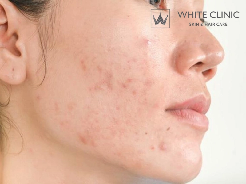 cách trị mụn tại nhà